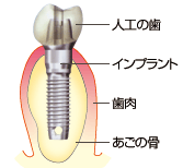 インプラントの構造