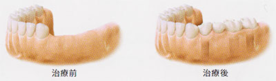 図：歯を複数本失った場合の治療前と治療後