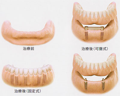 図：歯を全て失った場合の治療前と治療後